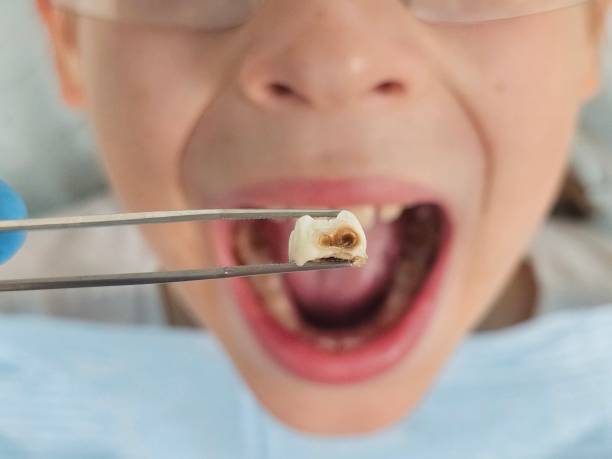 Best Emergency Tooth Extraction in Harbor Bluffs, FL